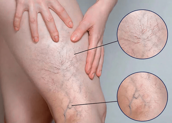 靜脈曲張不是靜脈瘤！愛開刀的醫生又一個新詐騙寵兒，這三招改善，避免被過時資訊的醫生騙去開刀！