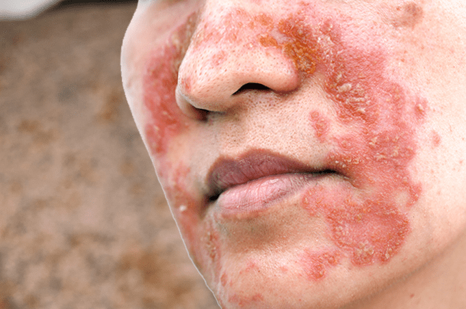 皮膚科專家解析敏感肌的保養 4 迷思!改善皮膚乾癢、泛紅、脫屑跳脫敏感肌